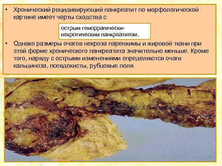  • Хронический рецидивирующий панкреатит по морфологической картине имеет черты сходства с острым геморрагическинекротическим