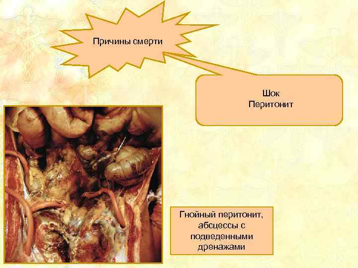 Причины смерти Шок Перитонит Гнойный перитонит, абсцессы с подведенными дренажами 