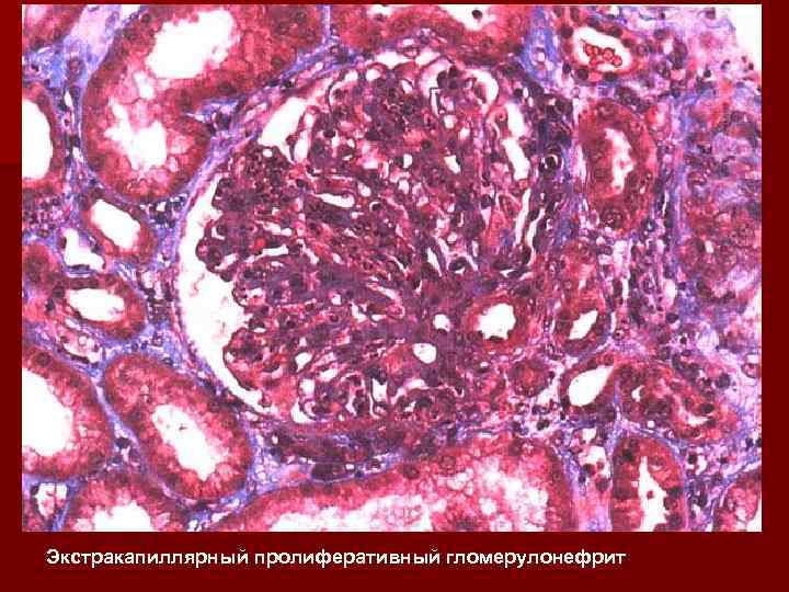 Экстракапиллярный пролиферативный гломерулонефрит 