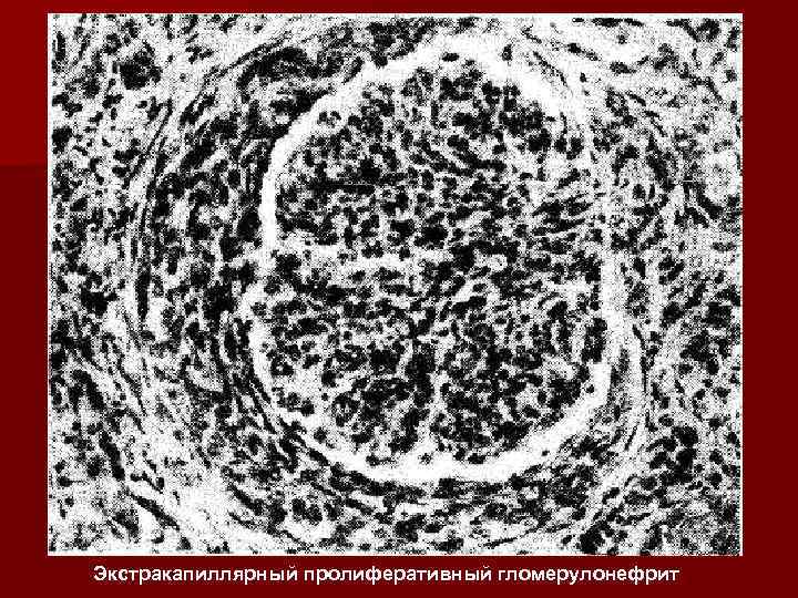 Экстракапиллярный пролиферативный гломерулонефрит 