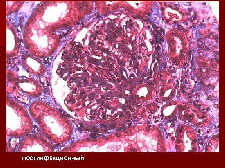 постинфекционный 