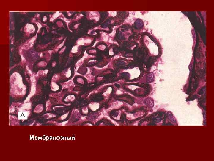 Мембранозный 