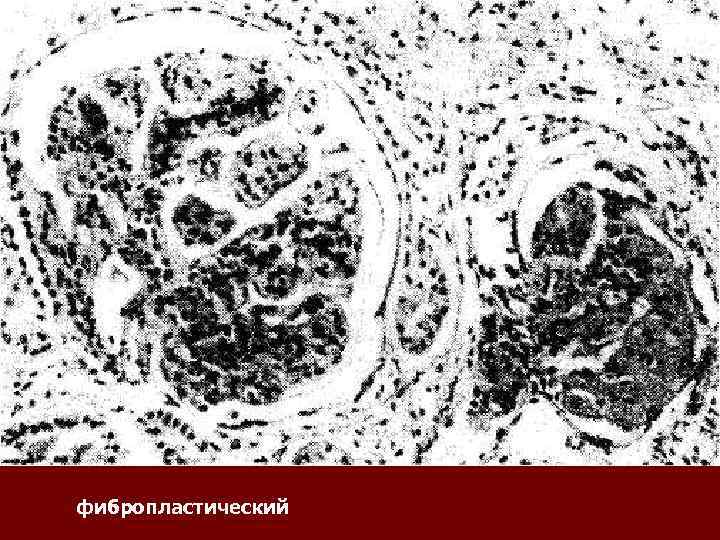 фибропластический 