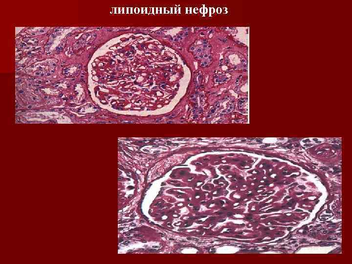 липоидный нефроз 