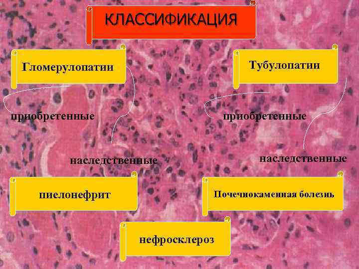 Краткая патологическая анатомия. Артериолосклеротический нефросклероз причины. Артериолосклеротическая почка. Гломерулопатия гломерулонефрит. Классификация заболеваний почек патанатомия.