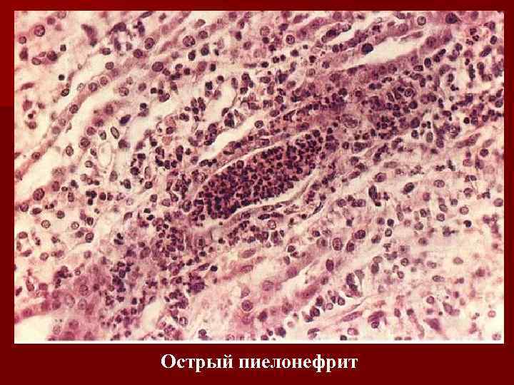 Острый пиелонефрит 