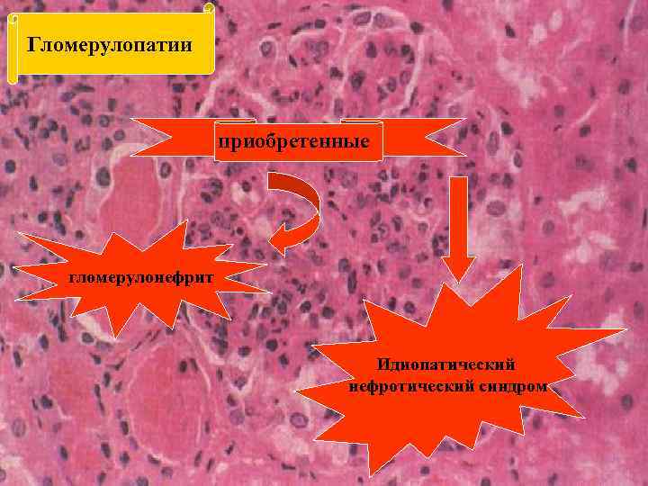 Гломерулопатии приобретенные гломерулонефрит Идиопатический нефротический синдром 