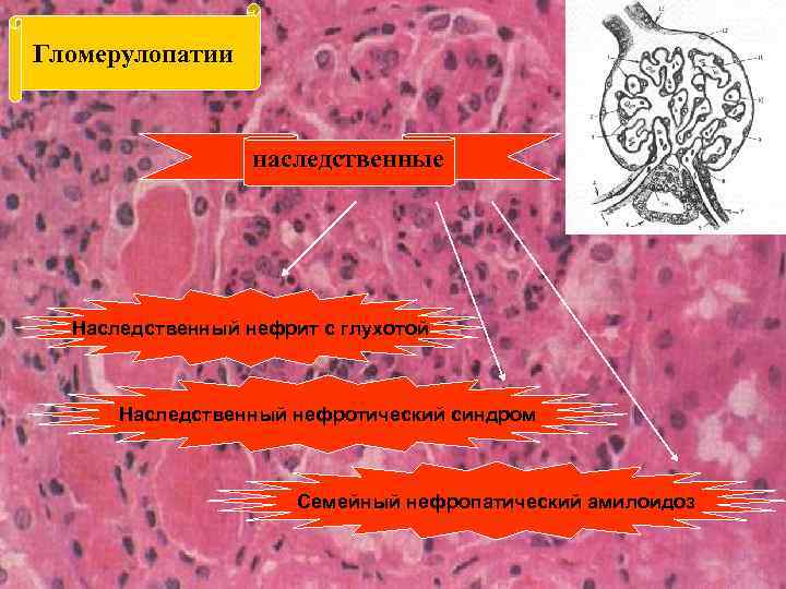 Гломерулопатии наследственные Наследственный нефрит с глухотой Наследственный нефротический синдром Семейный нефропатический амилоидоз 