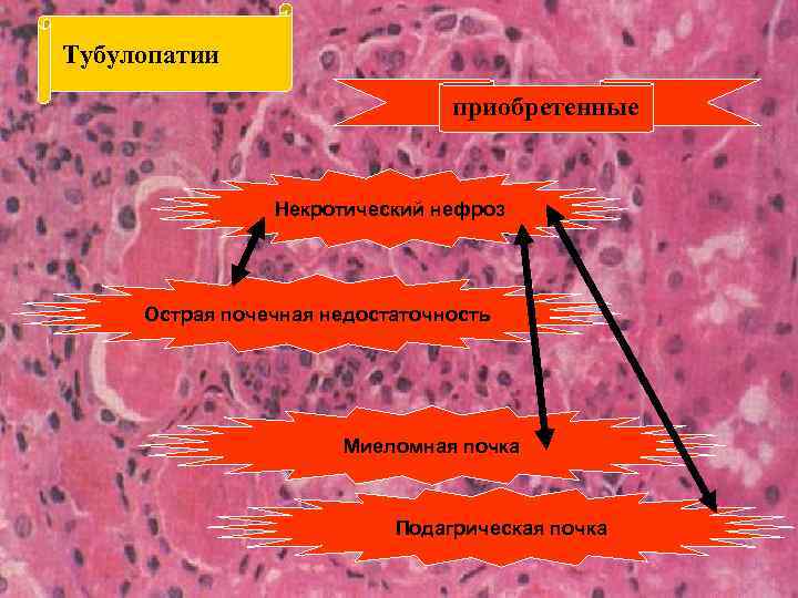 Тубулопатии приобретенные Некротический нефроз Острая почечная недостаточность Миеломная почка Подагрическая почка 