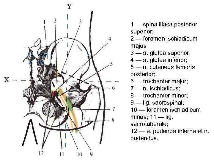 1 — spina iliaca posterior superior; 2 — foramen ischiadicum majus 3 — a.