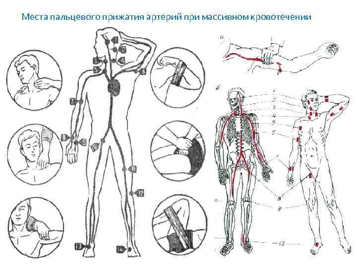 Пальцевое прижатие бедренной. Схема пальцевого прижатия артерий. Основные точки прижатия артерий для остановки кровотечения. Схема точек пальцевого прижатия. Места прижатия артерий схема.