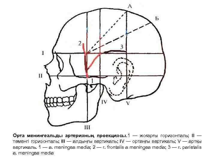 Орта менингеальды артерияның проекциясы. 1 — жоғарғы горизонталь; II — төменгі горизонталь; III —