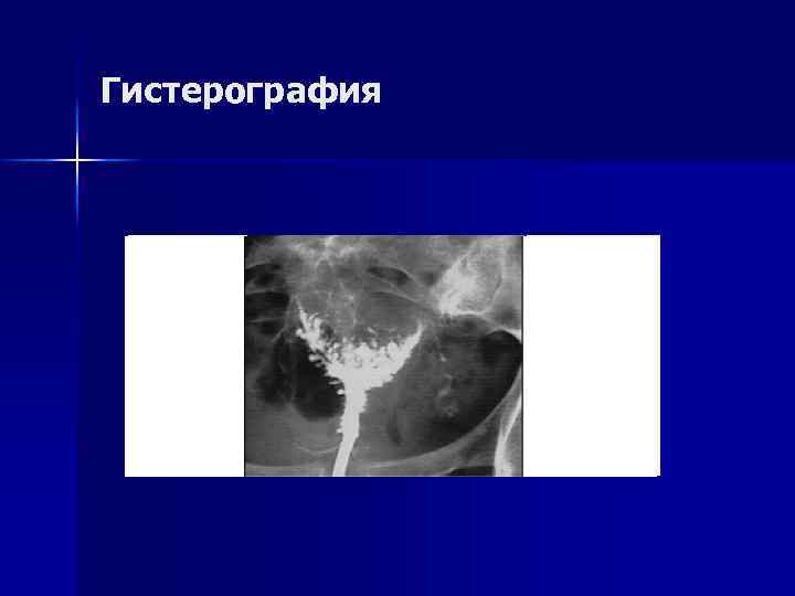 Гистерография 