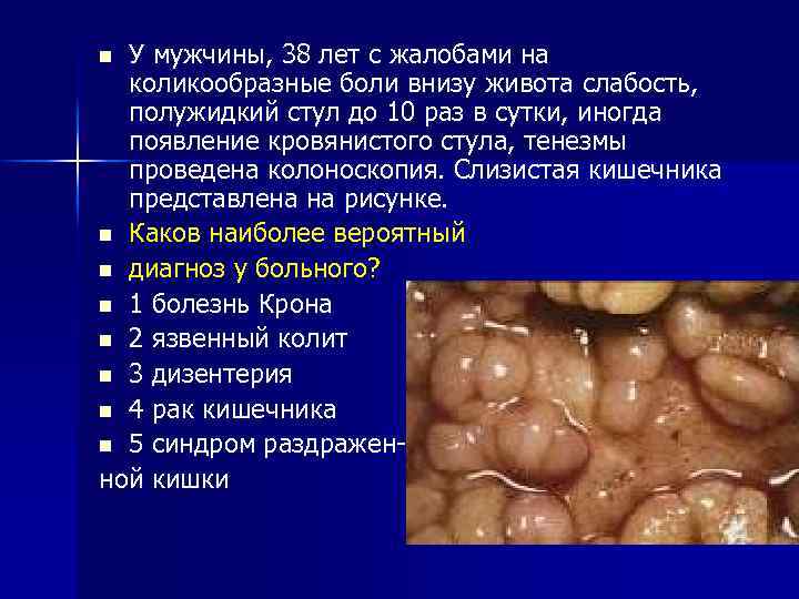 У мужчины, 38 лет с жалобами на коликообразные боли внизу живота слабость, полужидкий стул