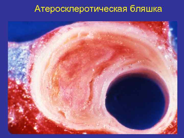 Атеросклеротическая бляшка 