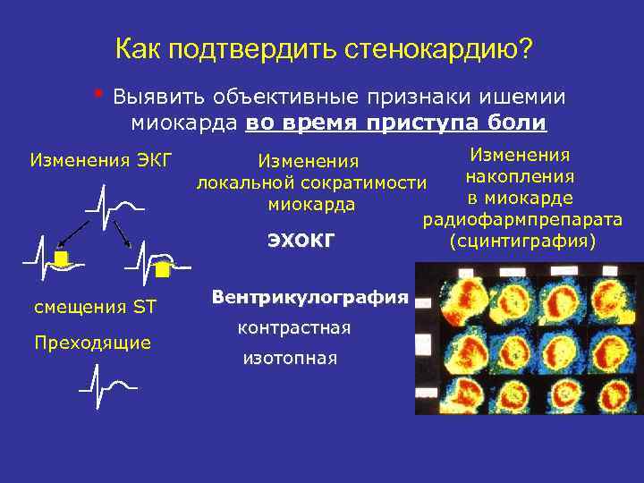 Как подтвердить стенокардию? h Выявить объективные признаки ишемии миокарда во время приступа боли Изменения