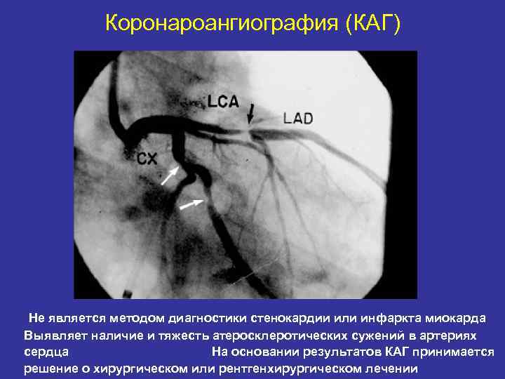 Коронароангиография (КАГ) Не является методом диагностики стенокардии или инфаркта миокарда Выявляет наличие и тяжесть