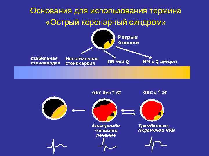 Основания для использования термина «Острый коронарный синдром» Разрыв бляшки стабильная стенокардия Нестабильная стенокардия ИМ