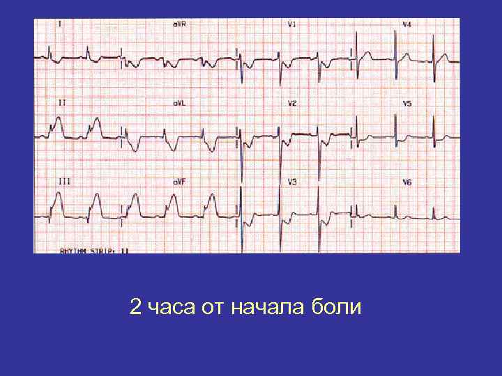 2 часа от начала боли 