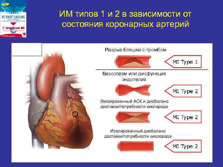 ИМ типов 1 и 2 в зависимости от состояния коронарных артерий Разрыв бляшки с