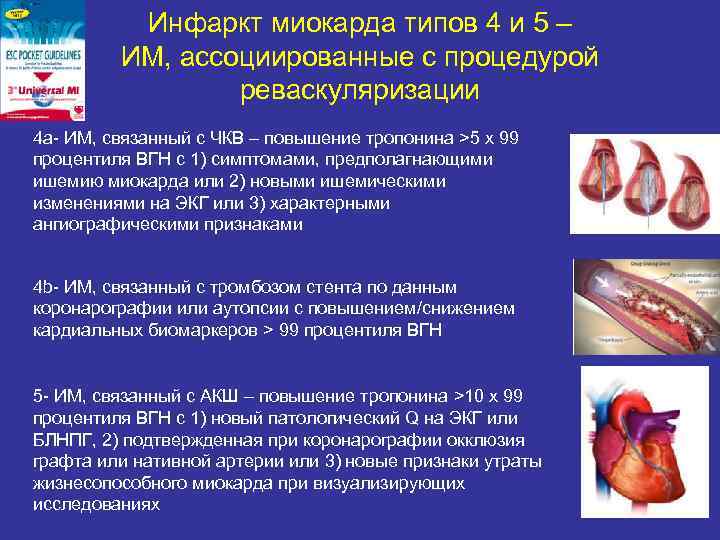 Инфаркт миокарда типов 4 и 5 – ИМ, ассоциированные с процедурой реваскуляризации 4 а-