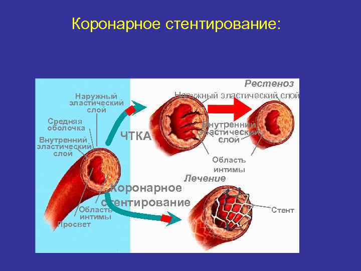 Коронарное стентирование: Рестеноз Наружный эластический слой Средняя оболочка ЧТКА Внутренний эластический слой Наружный эластический