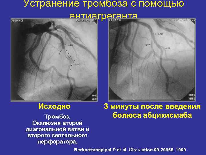 Устранение тромбоза с помощью антиагреганта Исходно Тромбоз. Окклюзия второй диагональной ветви и второго септального