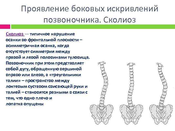 Фронтальная плоскость позвоночника. Изгибы позвоночника во фронтальной плоскости. Искривление позвоночника во фронтальной плоскости. Сколиоз во фронтальной плоскости. Сколиозы (искривление во фронтальной плоскости.