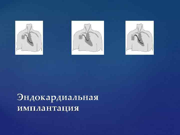 Эндокардиальная имплантация 