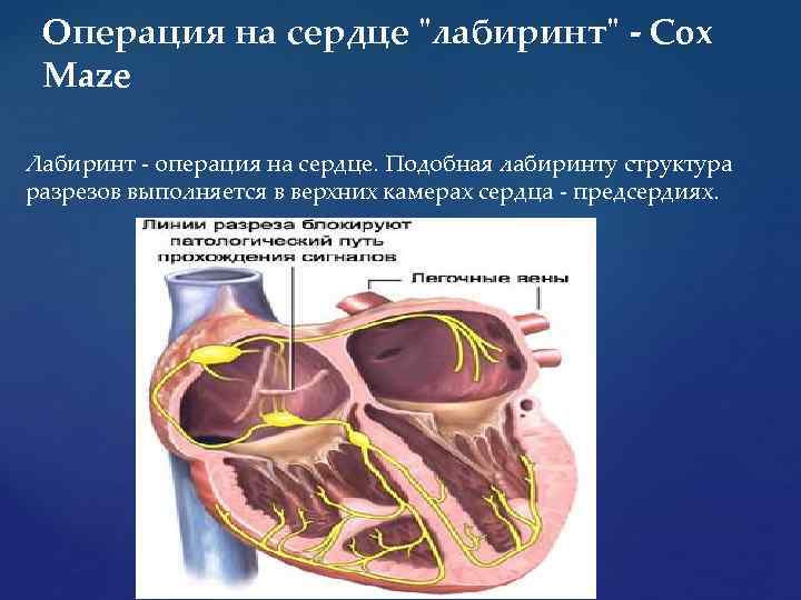 Операция на сердце 