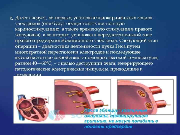  Далее следует, во-первых, установка эндокардиальных зондовэлектродов (они будут осуществлять постоянную кардиостимуляцию, а также