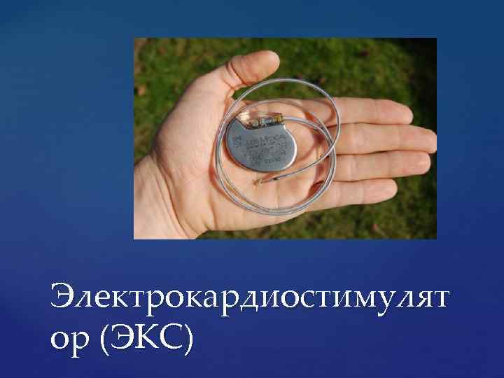 Электрокардиостимулят ор (ЭКС) 