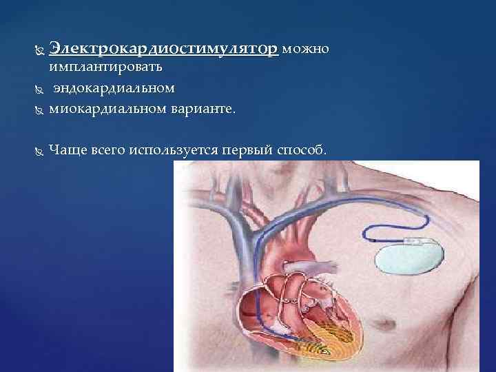  Электрокардиостимулятор можно имплантировать эндокардиальном миокардиальном варианте. Чаще всего используется первый способ. 