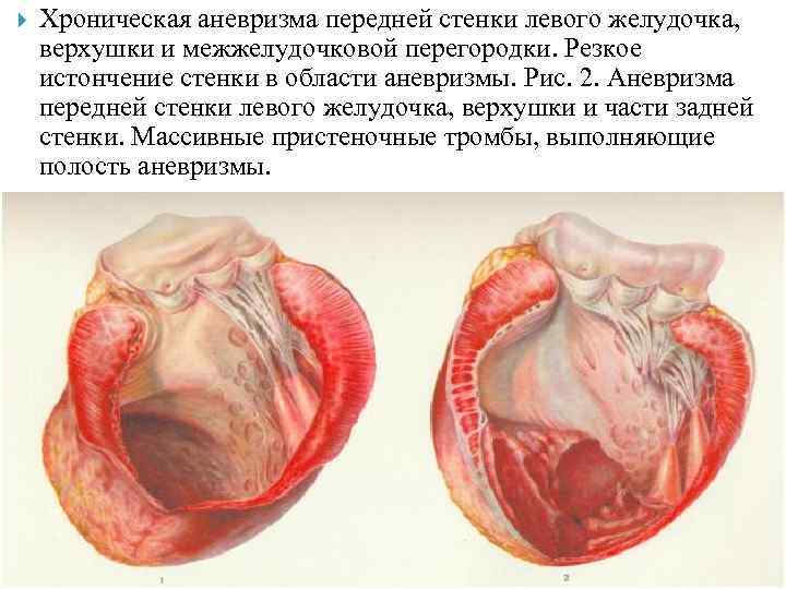  Хроническая аневризма передней стенки левого желудочка, верхушки и межжелудочковой перегородки. Резкое истончение стенки