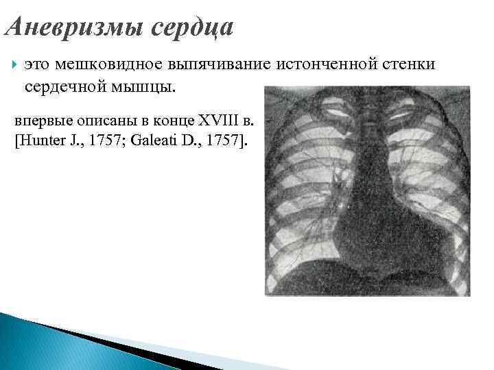 Аневризмы сердца это мешковидное выпячивание истонченной стенки сердечной мышцы. впервые описаны в конце XVIII