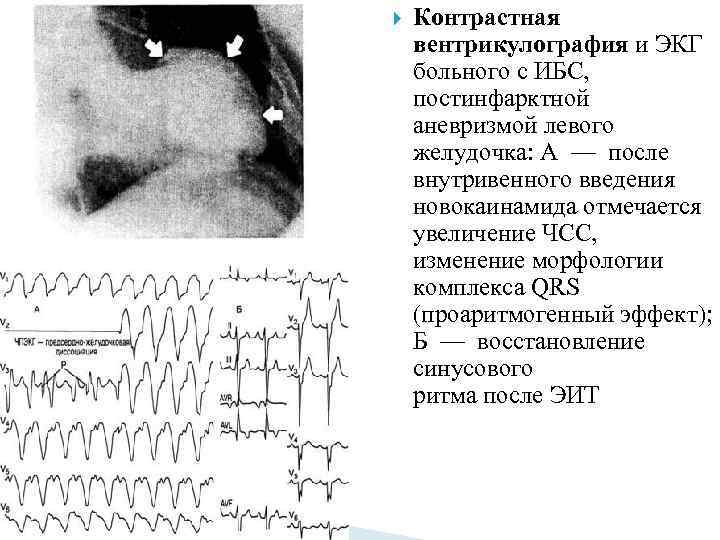 Картине истинной аневризмы в области верхушки миокарда левого желудочка соответствует