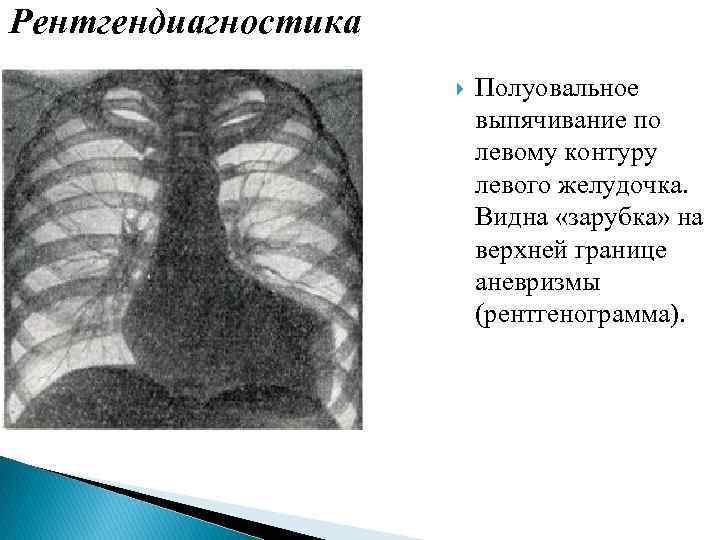 Рентгендиагностика Полуовальное выпячивание по левому контуру левого желудочка. Видна «зарубка» на верхней границе аневризмы