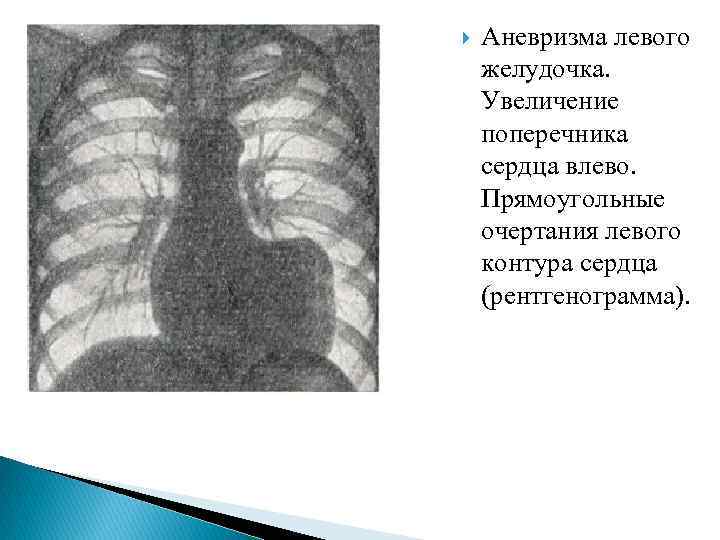  Аневризма левого желудочка. Увеличение поперечника сердца влево. Прямоугольные очертания левого контура сердца (рентгенограмма).