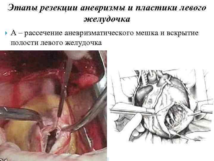 Этапы резекции аневризмы и пластики левого желудочка А – рассечение аневризматического мешка и вскрытие