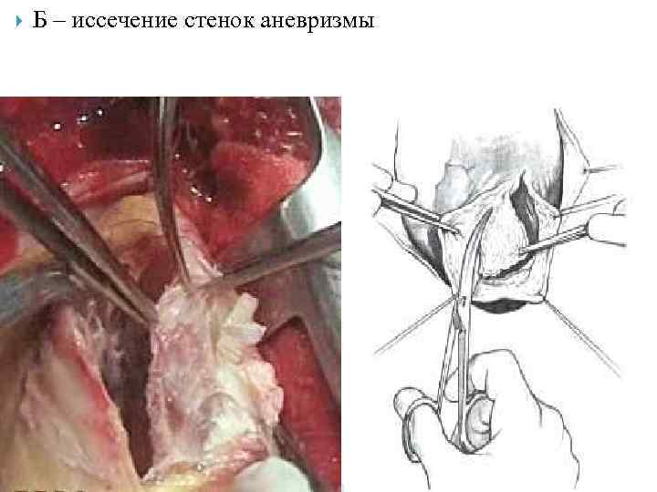  Б – иссечение стенок аневризмы 