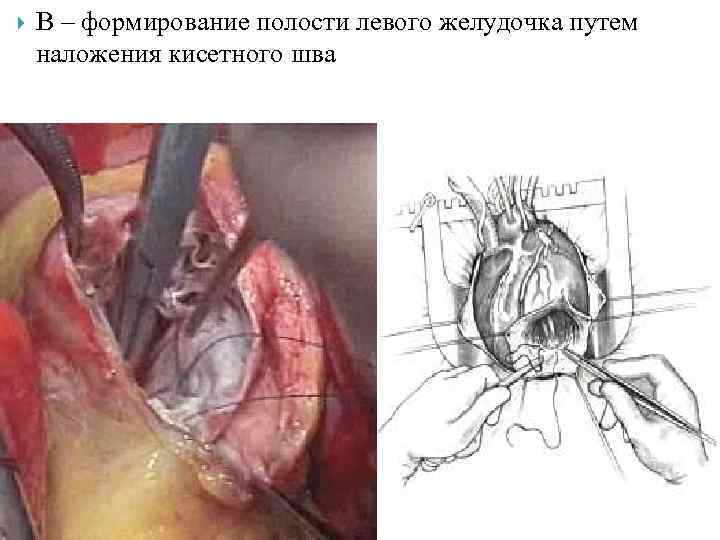  В – формирование полости левого желудочка путем наложения кисетного шва 