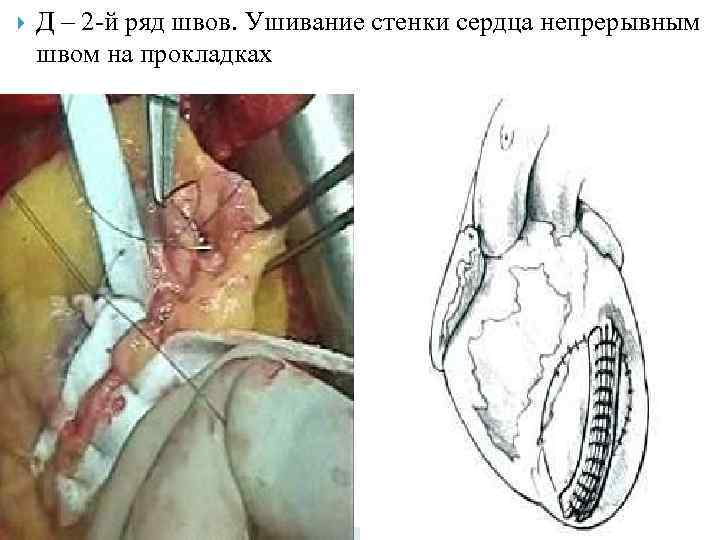  Д – 2 -й ряд швов. Ушивание стенки сердца непрерывным швом на прокладках