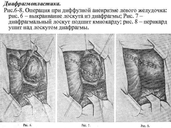 Диафрагмопластика. Рис. 6 -8. Операция при диффузной аневризме левого желудочка: рис. 6 – выкраивание