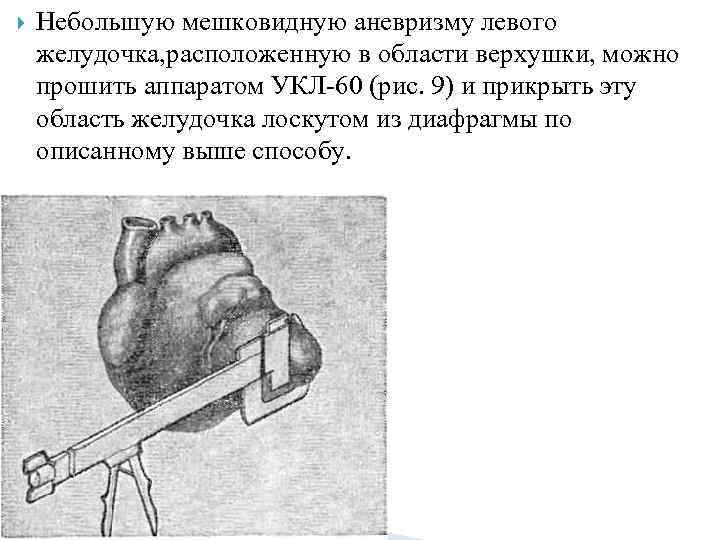  Небольшую мешковидную аневризму левого желудочка, расположенную в области верхушки, можно прошить аппаратом УКЛ-60