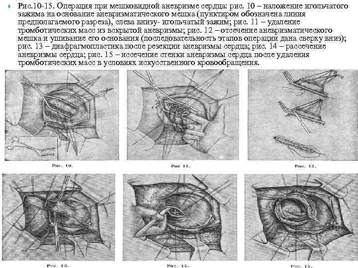  Рис. 10 -15. Операция при мешковидной аневризме сердца: рис. 10 – наложение игольчатого