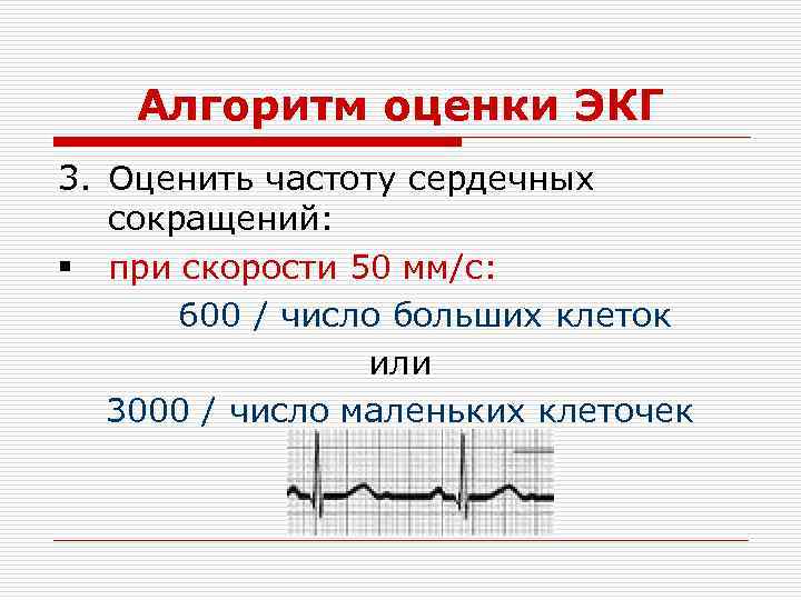 Алгоритм оценки ЭКГ 3. Оценить частоту сердечных сокращений: § при скорости 50 мм/с: 600