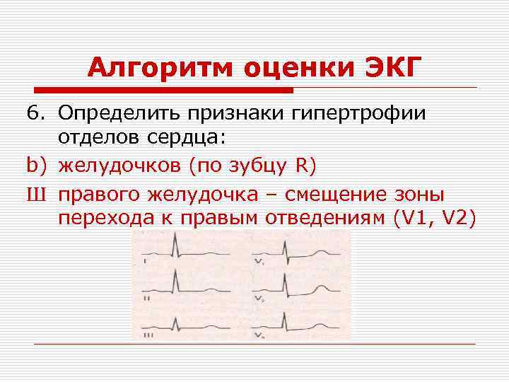 Алгоритм оценки ЭКГ 6. Определить признаки гипертрофии отделов сердца: b) желудочков (по зубцу R)