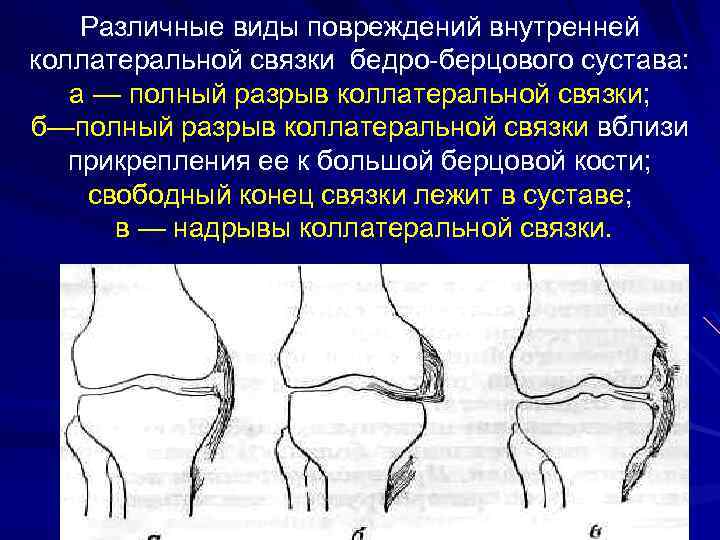 Различные виды повреждений внутренней коллатеральной связки бедро-берцового сустава: а — полный разрыв коллатеральной связки;