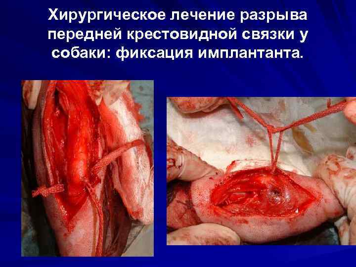 Хирургическое лечение разрыва передней крестовидной связки у собаки: фиксация имплантанта. 