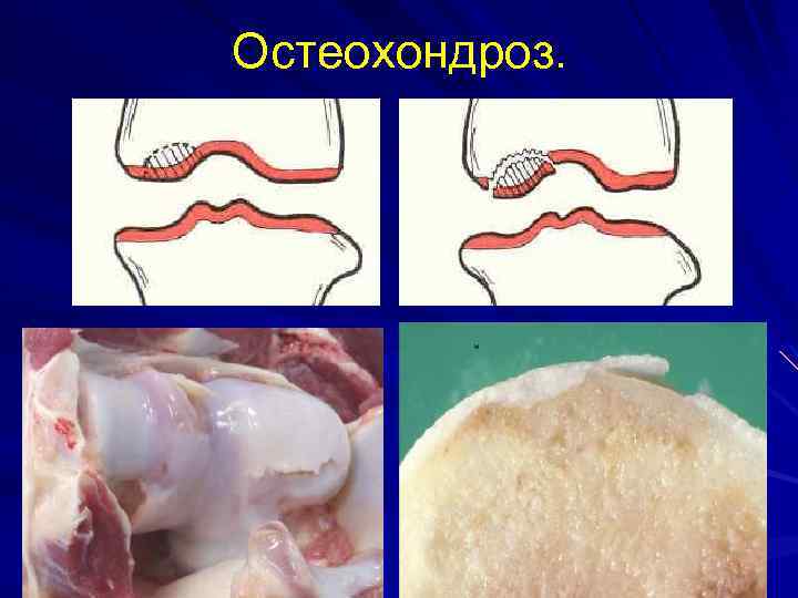 Остеохондроз. 